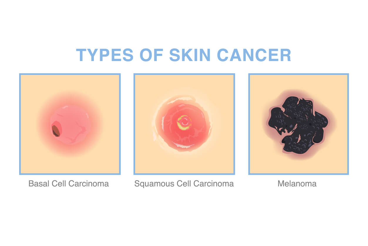 skin cancer types basal cell carcinoma